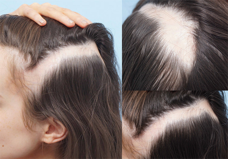 Linear Morphea en Coup de Sabre (LM ECDS) - American Board of Hair  Restoration Society