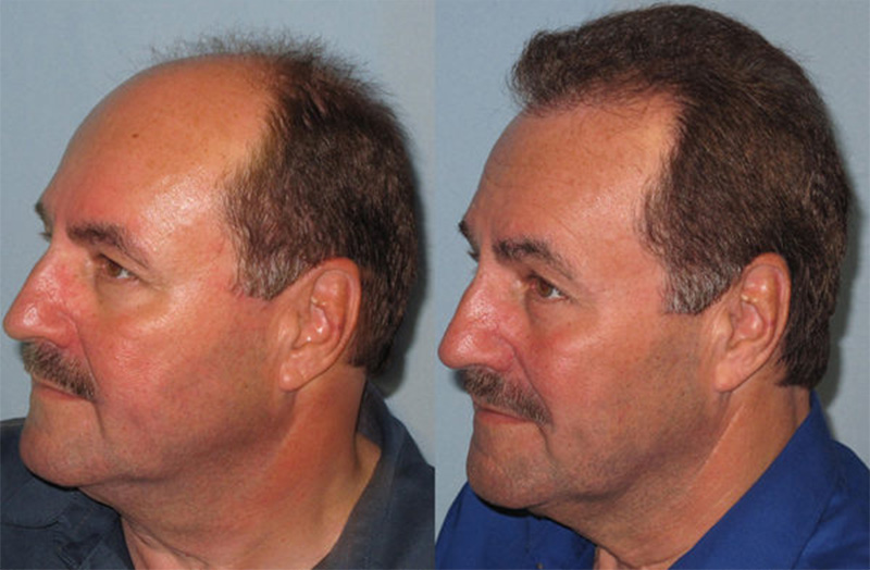 Hair Restoration with Strip Harvest in a Male Patient with Severe Hair Loss  - American Board of Hair Restoration Society