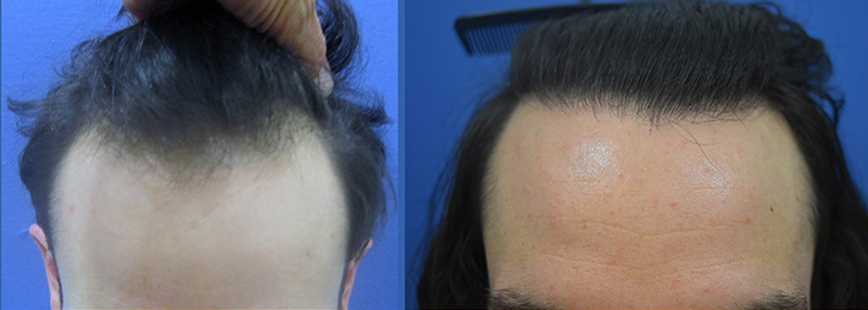 Hair restoration in a female patient post craniotomy and radiation  treatment for Astrocytoma. (malignant brain tumor) - American Board of Hair  Restoration Society