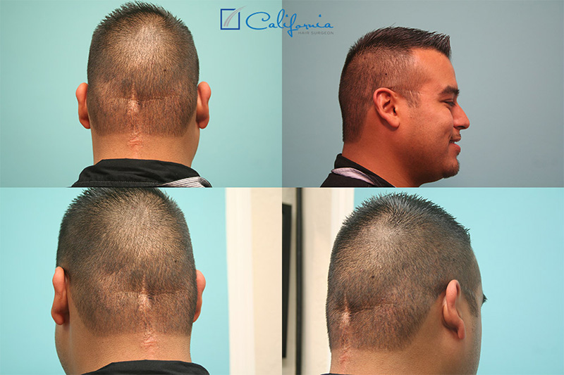 Hair Transplant Repair Of Scarring From Cancer Treatments - American Board  of Hair Restoration Society