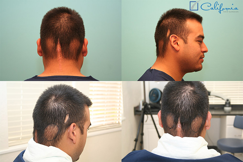 Hair Transplant Repair Of Scarring From Cancer Treatments - American Board  of Hair Restoration Society
