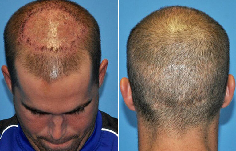 FUE Hair Transplantation- Scar Tissue Following MRSA Infection ...