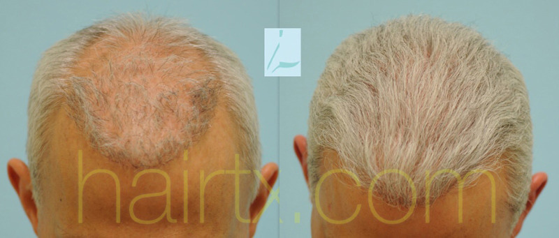 Hair restoration in a female patient post craniotomy and radiation  treatment for Astrocytoma. (malignant brain tumor) - American Board of Hair  Restoration Society